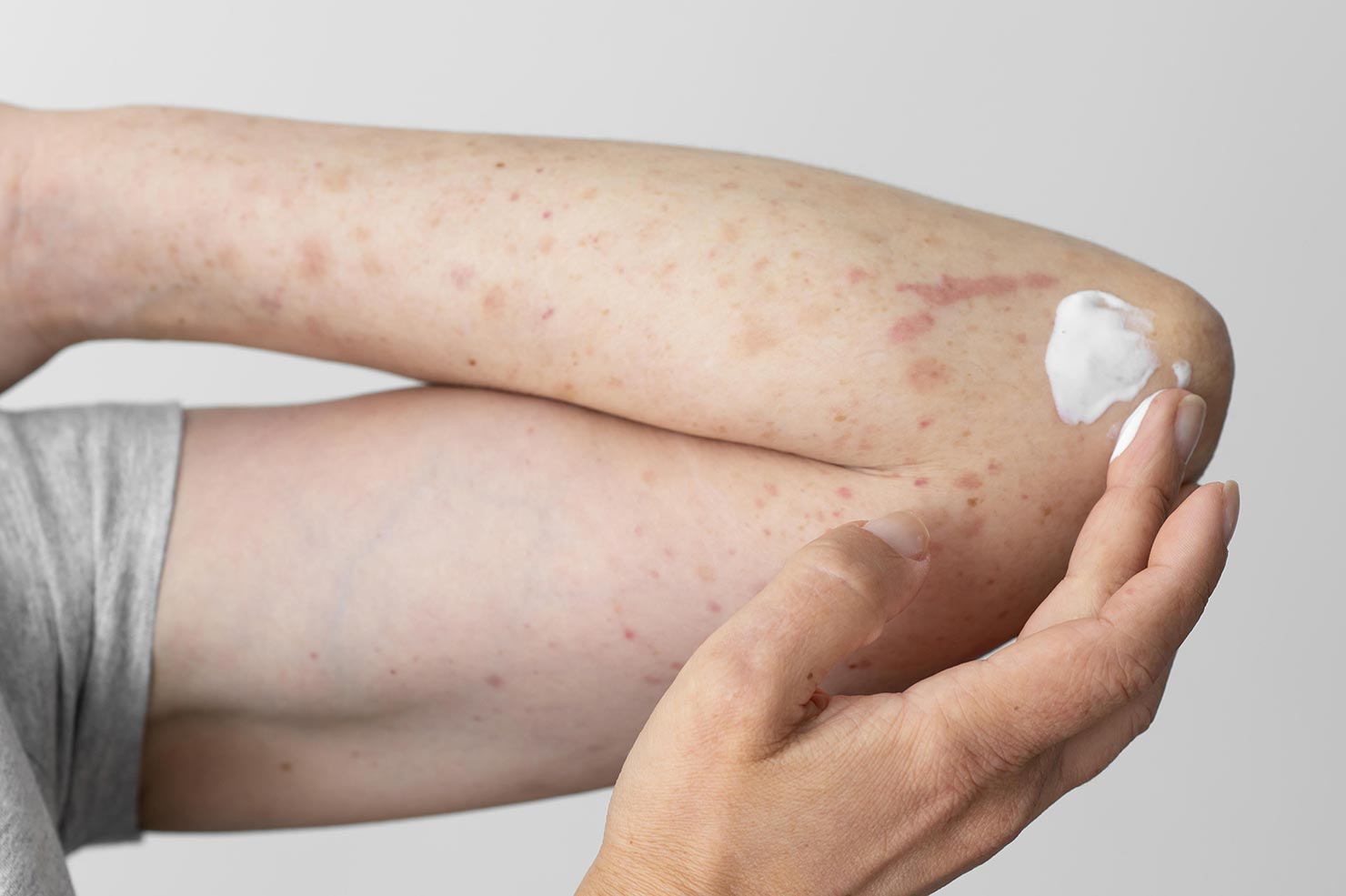 Psoriasis-biopoost